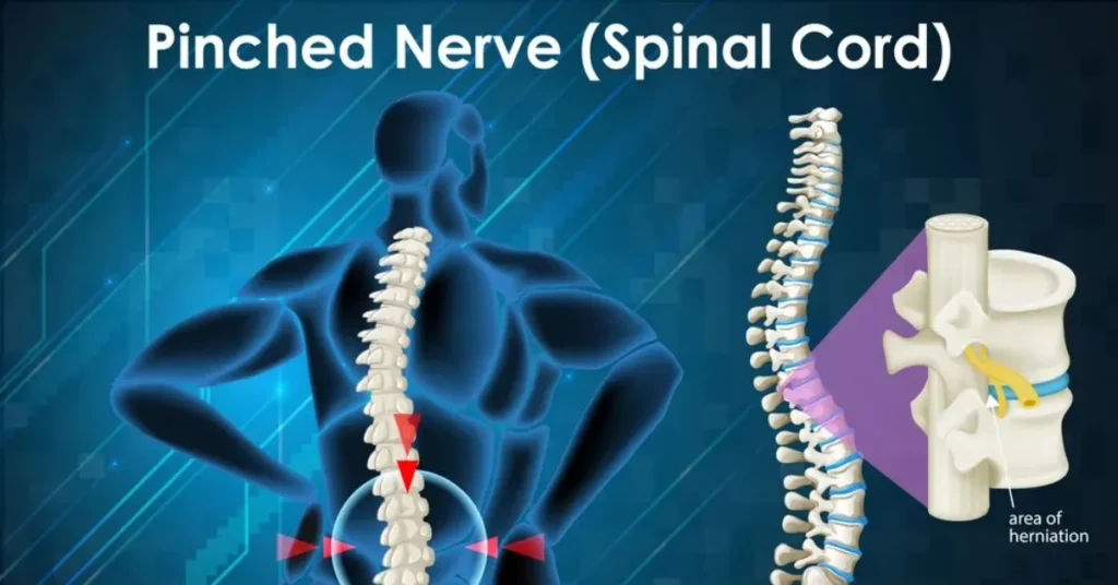 A Pinched Nerve Feel