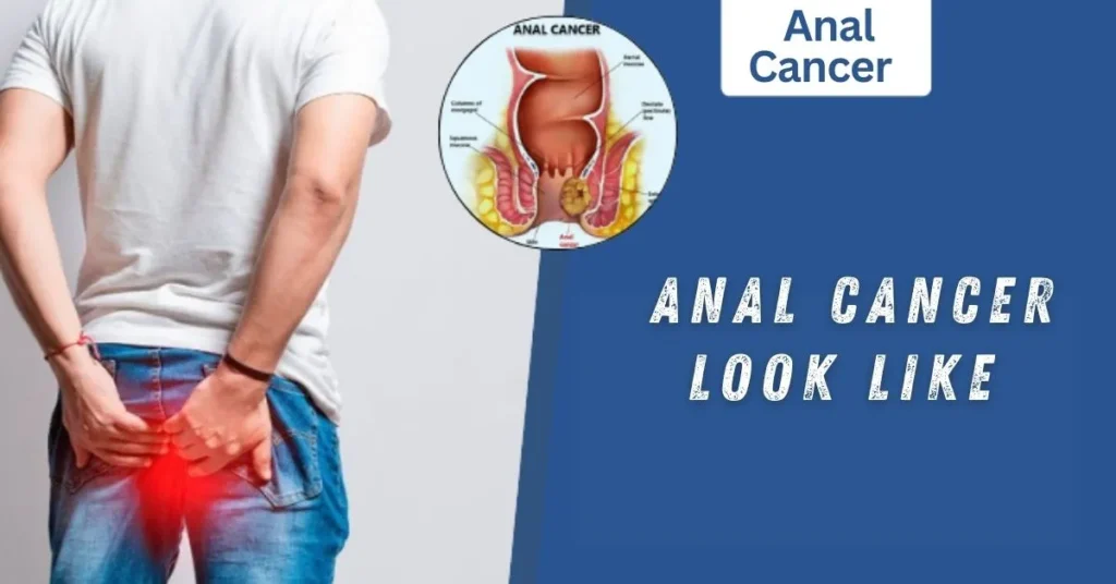 Anal Cancer Look Like
