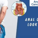 Anal Cancer Look Like