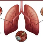 Vaping Do to Your Lungs