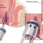 A Hemorrhoid Feel Like