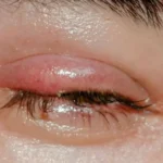 A Stye Look Like