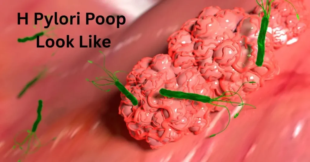 H Pylori Poop Look Like